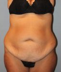 Patient Liposuction Thumbnail Before 0