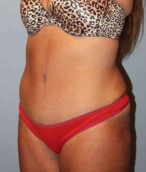 Patient Liposuction Before 1