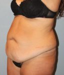 before liposuction front angle view female case 1042