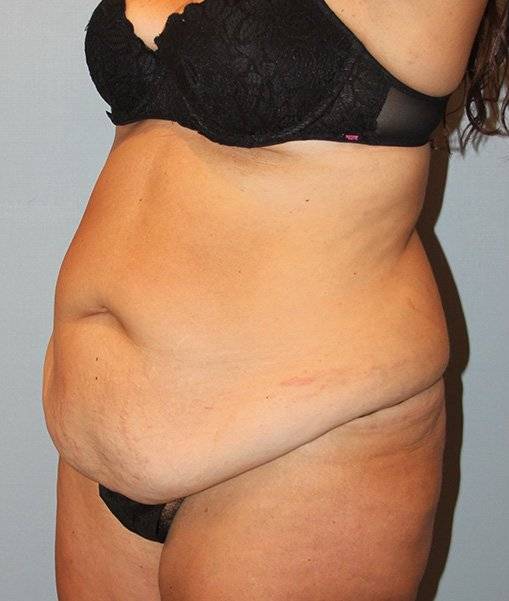 Patient Liposuction Before 1