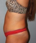 Patient Liposuction Thumbnail After 2