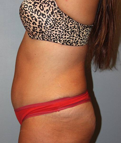 Patient Liposuction Before 2