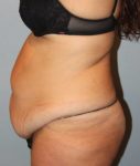 Patient Liposuction Thumbnail Before 2
