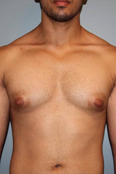 before liposuction front view male case 1050