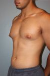 Patient Liposuction Thumbnail Before 1