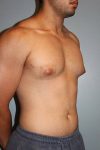 before liposuction front angle view male case 1050