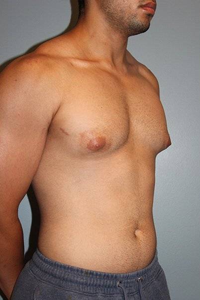 before liposuction front angle view male case 1050