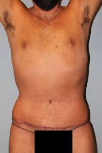 Patient Liposuction After 0