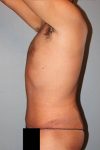 after liposuction side view male case 1064