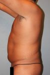 before liposuction side view male case 1064