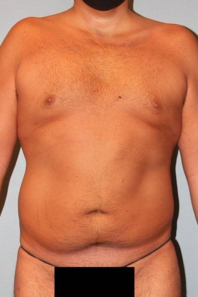 before liposuction front view male case 1064