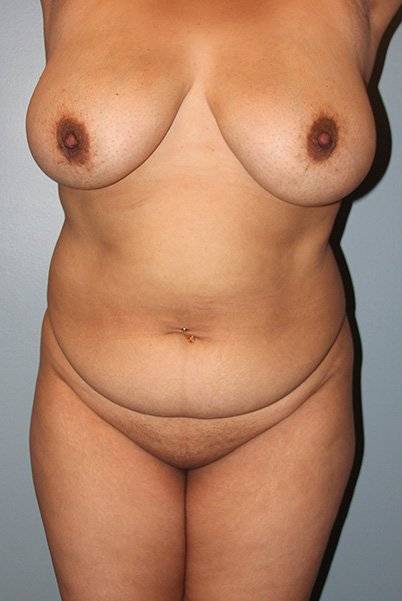 before liposuction front view female case 1080