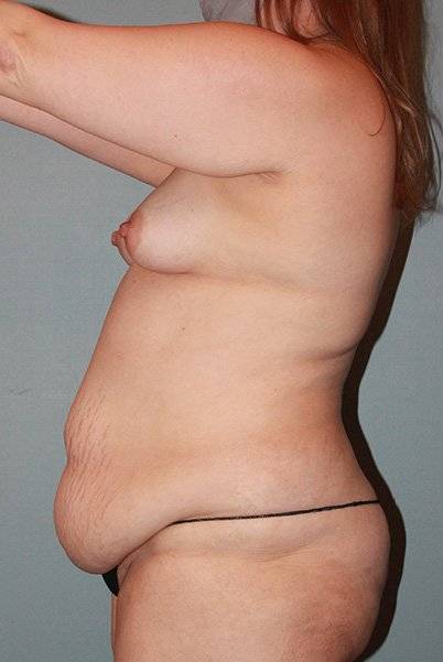 before liposuction side view female case 1110