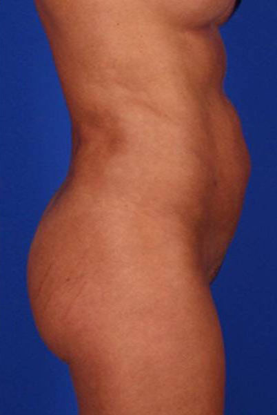 Patient Liposuction Before 2