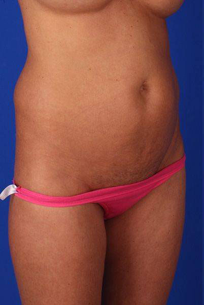 Patient Liposuction Before 1