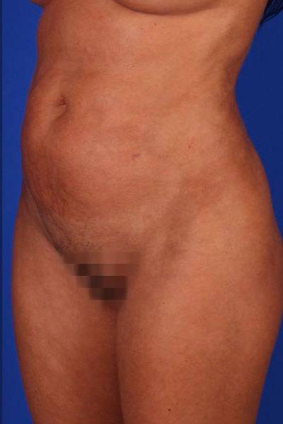 Patient Liposuction Before 0