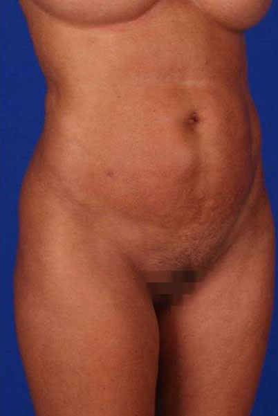 Patient Liposuction Before 1