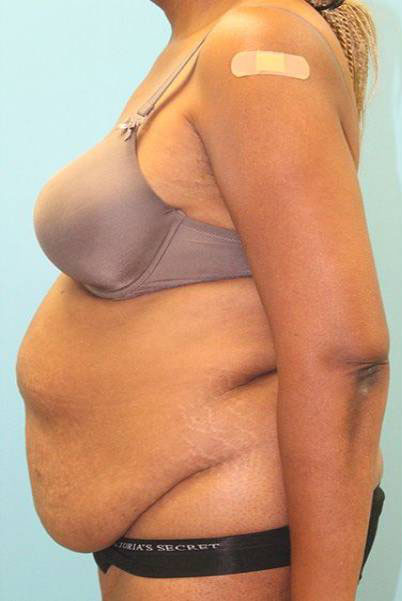 Patient Liposuction Before 2