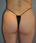 Patient Liposuction Thumbnail After 4