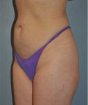 Patient Liposuction Thumbnail Before 1