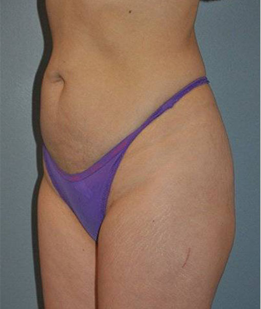 Patient Liposuction Before 1