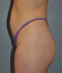 Patient Liposuction Thumbnail Before 2