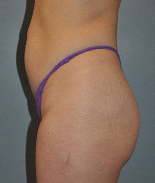 Patient Liposuction Before 2