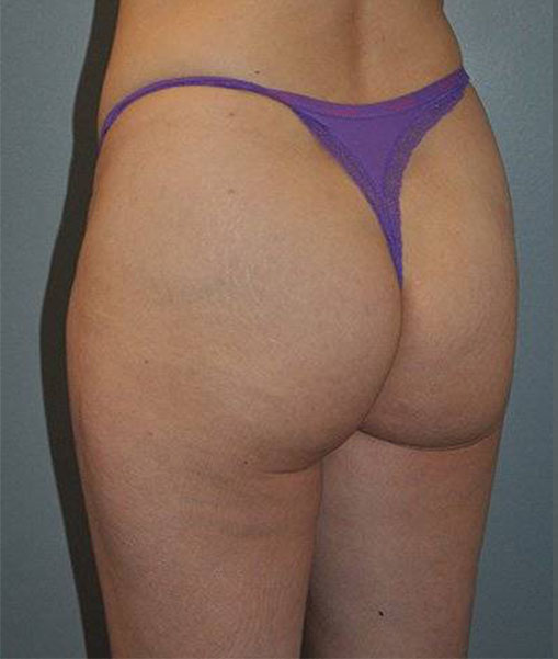 Patient Liposuction Before 3