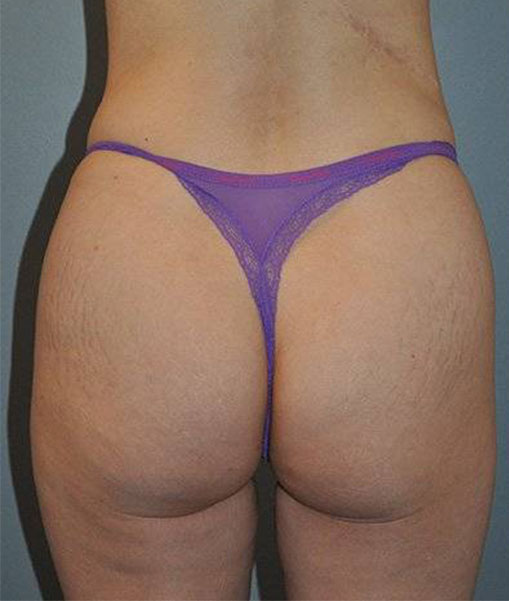 Patient Liposuction Before 4
