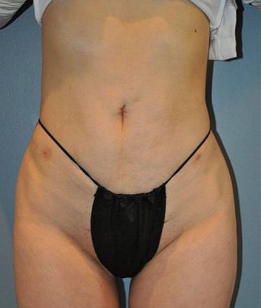 Patient Liposuction Before 0