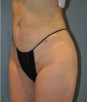 Patient Liposuction Thumbnail After 1