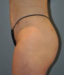 Patient Liposuction Thumbnail After 2