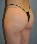 Patient Liposuction Thumbnail After 3