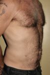 Patient Liposuction Thumbnail After 1