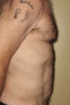 Patient Liposuction Thumbnail After 2