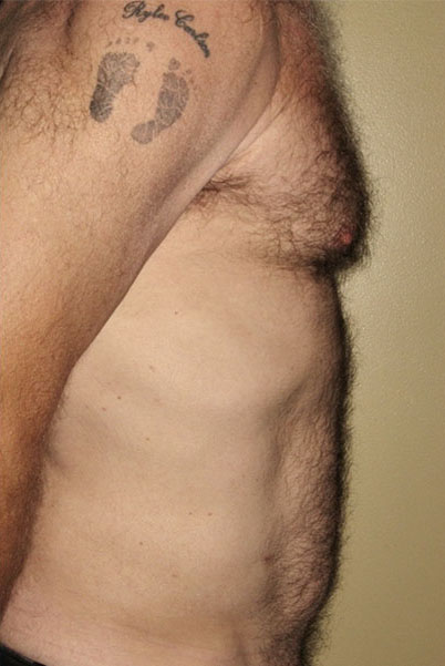 Patient Liposuction Before 2