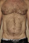 Patient Liposuction Thumbnail Before 0