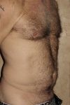 Patient Liposuction Thumbnail Before 1