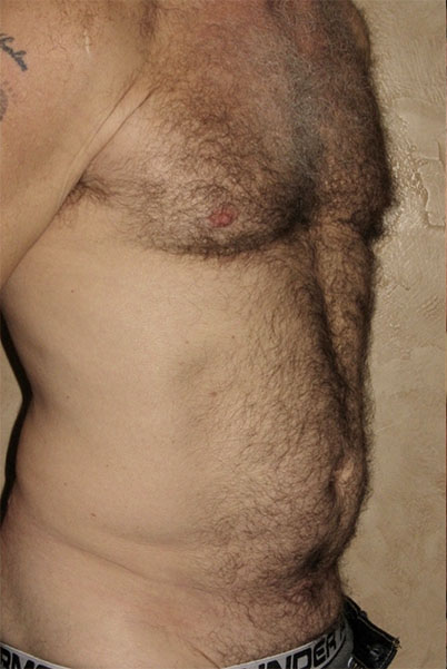 Patient Liposuction Before 1