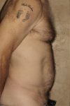 Patient Liposuction Thumbnail Before 2