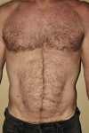 Patient Liposuction Thumbnail After 0