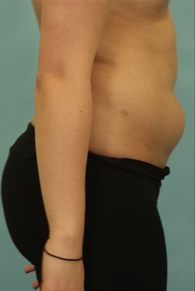 Patient Liposuction Before 2