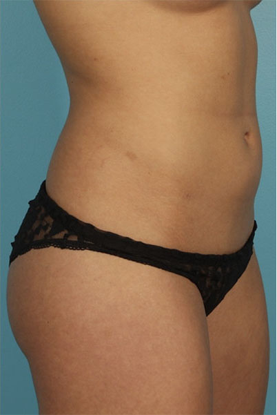 Patient Liposuction Before 1