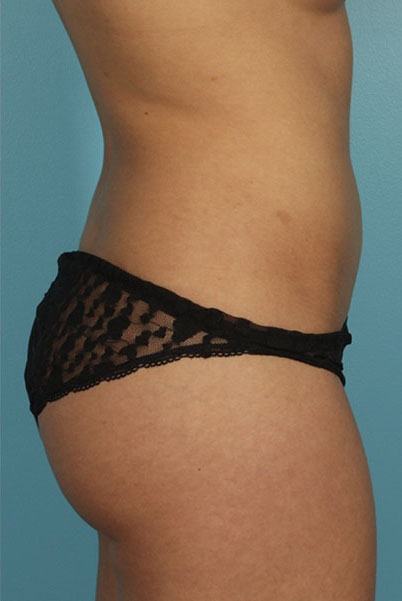 Patient Liposuction Before 2