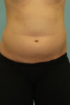 Patient Liposuction Thumbnail Before 0