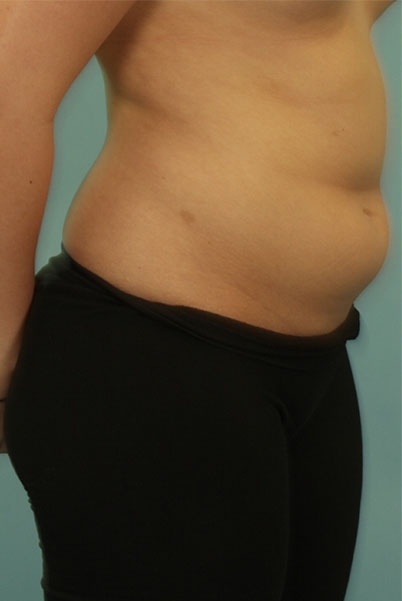 Patient Liposuction Before 1