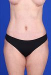 after liposuction front view female case 979