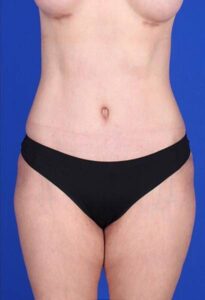 Patient Liposuction After 0