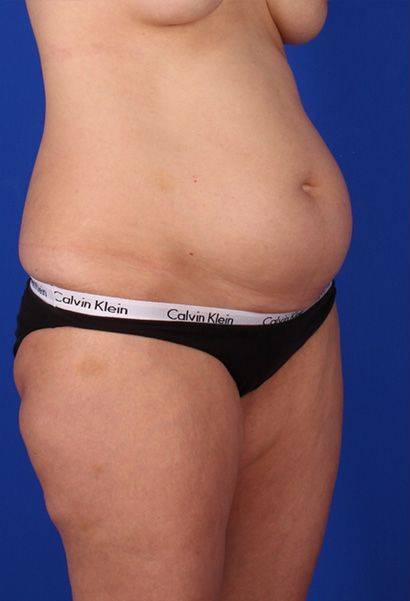 before liposuction angle view female case 979