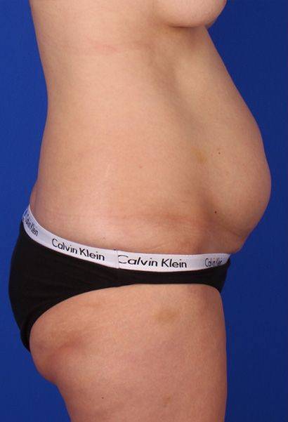 before liposuction side view female case 979